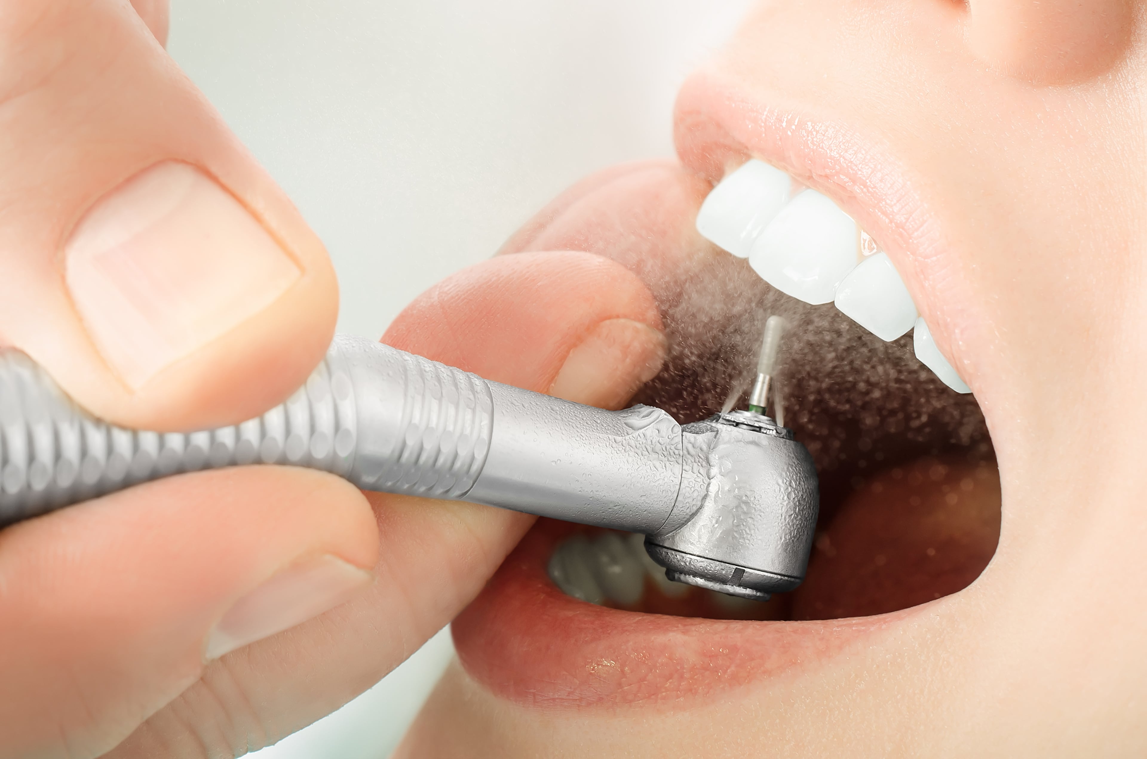 Чистка зубов после лечения. Аппарат АИР флоу стоматология. Профессиональная гигиена полости рта.