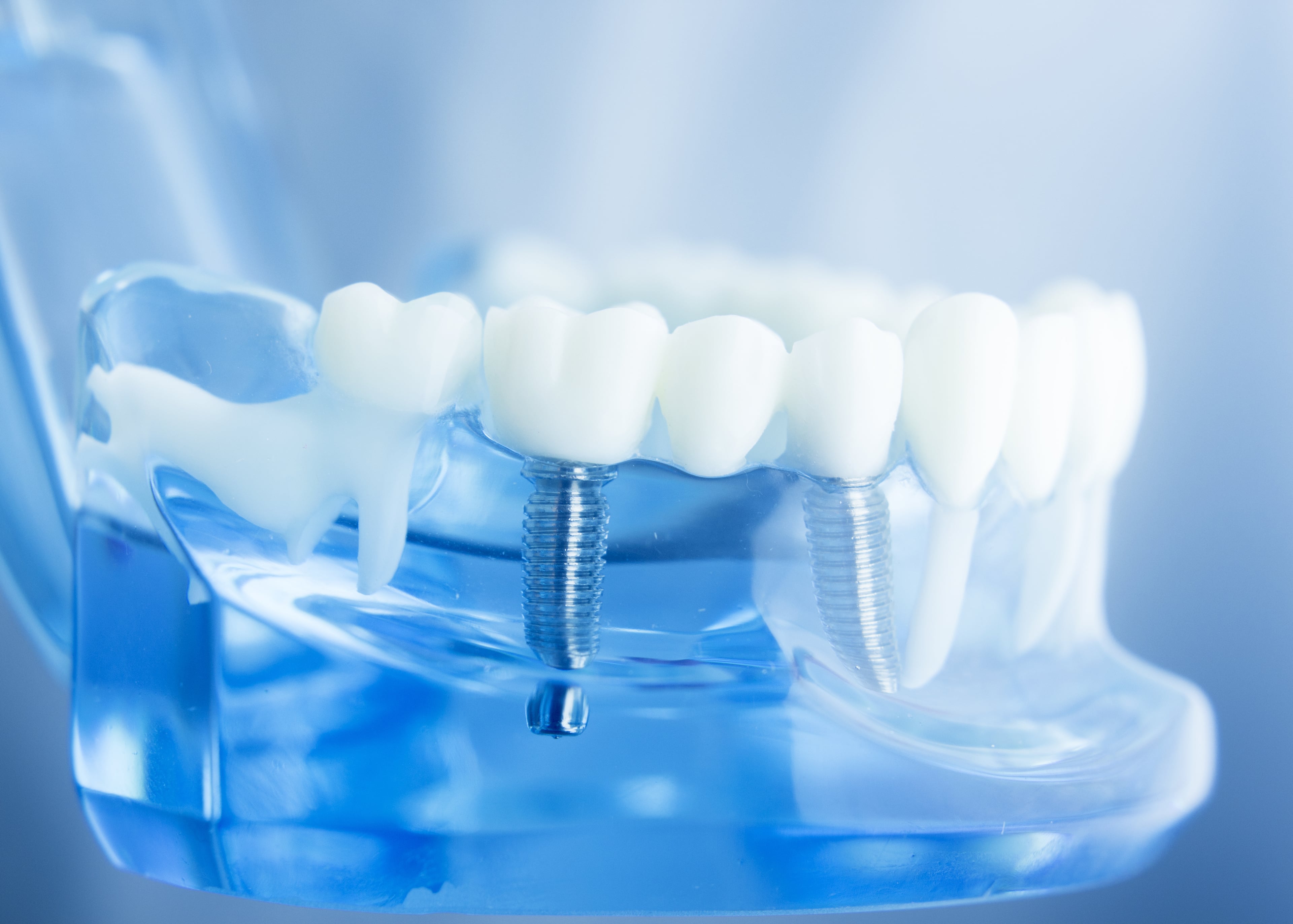 Как называется протезист. Дентал имплант. Красивые зубы стоматология. Стоматология имплантация зубов.